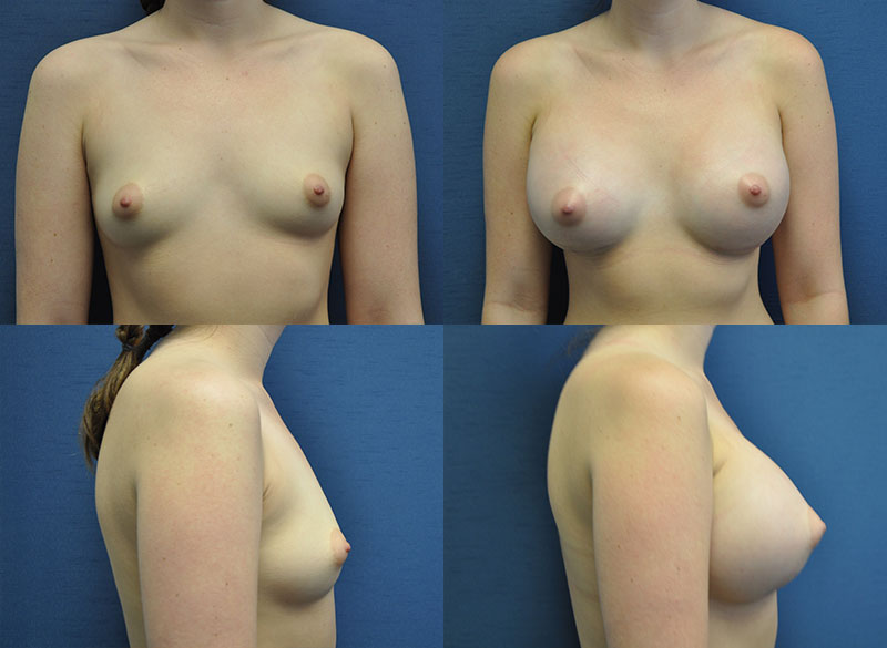 Before & After Breast Augmentation Performed by Dr. Casper