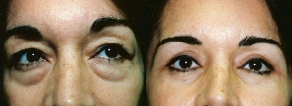 Eyelid Surgery Los Angeles