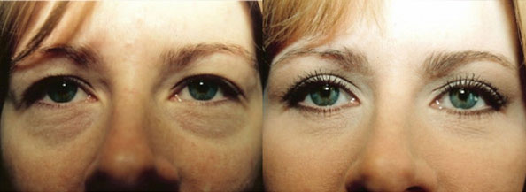 Eyelid Surgery Los Angeles