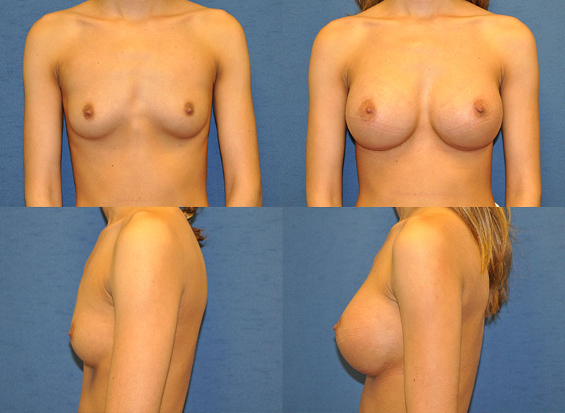 Before and After breast augmentation by Dr. Casper
