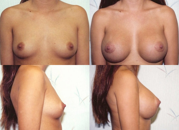 Breast Augmentation Before and After | Daniel J. Casper M.D.