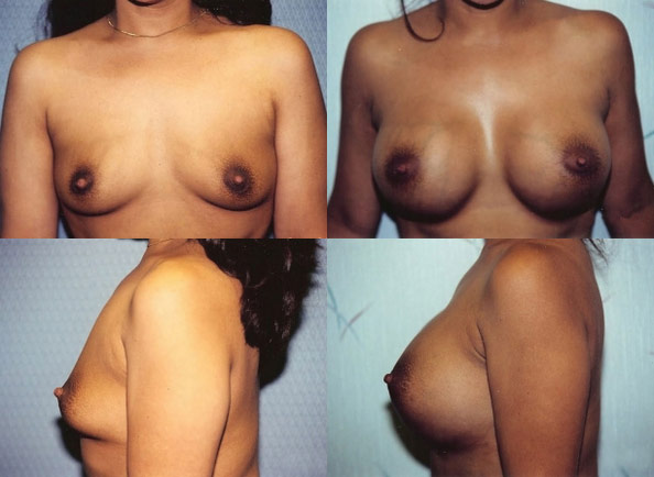 Breast Augmentation Before and After | Daniel J. Casper M.D.