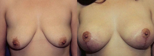 Breast Lift Los Angeles