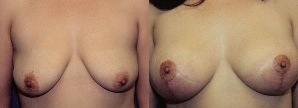 Breast Lift Before and After | Daniel J. Casper M.D.