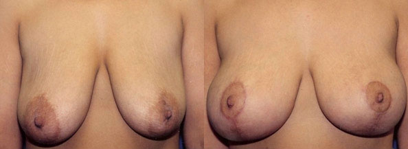 Breast Lift Los Angeles