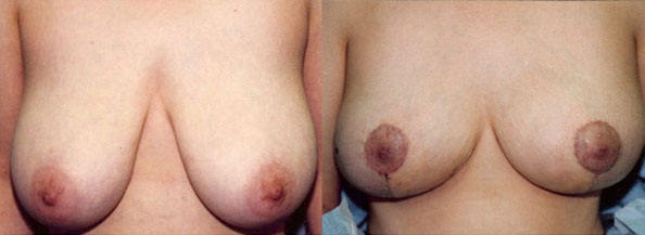 Breast Reduction Los Angeles