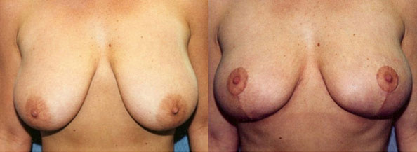 Breast Reduction Los Angeles