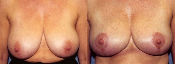 Breast Reduction Los Angeles