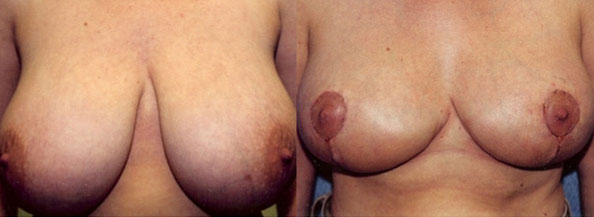Breast Reduction Before and After | Daniel J. Casper M.D.