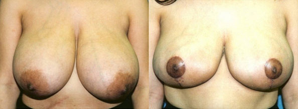 Breast Reduction Before and After | Daniel J. Casper M.D.