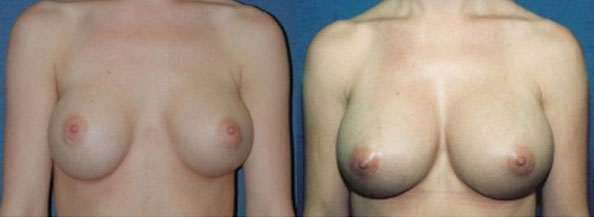 Breast Revision Before and After | Daniel J. Casper M.D.