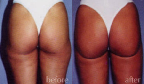Liposuction Before and After | Daniel J. Casper M.D.