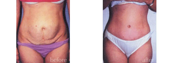 Tummy Tuck Los Angeles