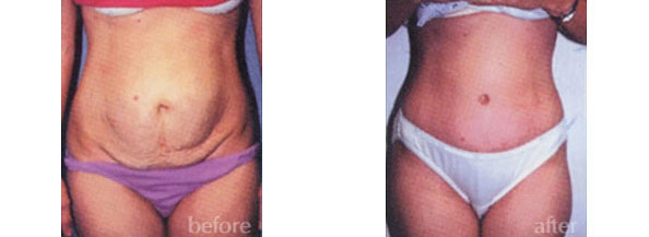 Tummy Tuck Scars Before and After Photo Gallery, Los Angeles, CA
